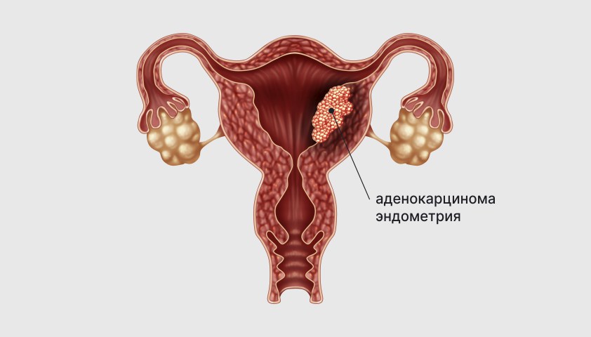 Гиперплазия эндометрия матки — что это, симптомы и лечение