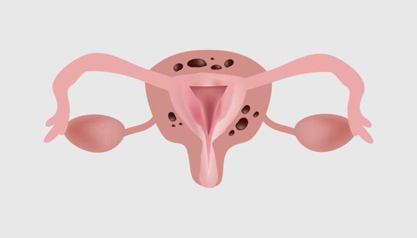 Аденомиоз - что это такое у женщин, симптомы, причины, лечение