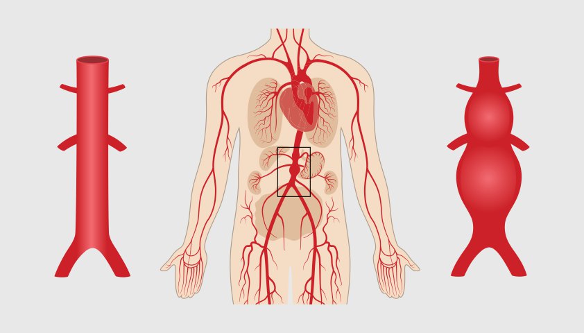 Изображение аневризмы аорты