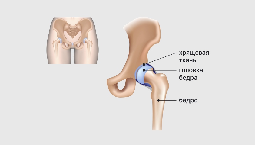 Осложнения артроза тазобедренного сустава