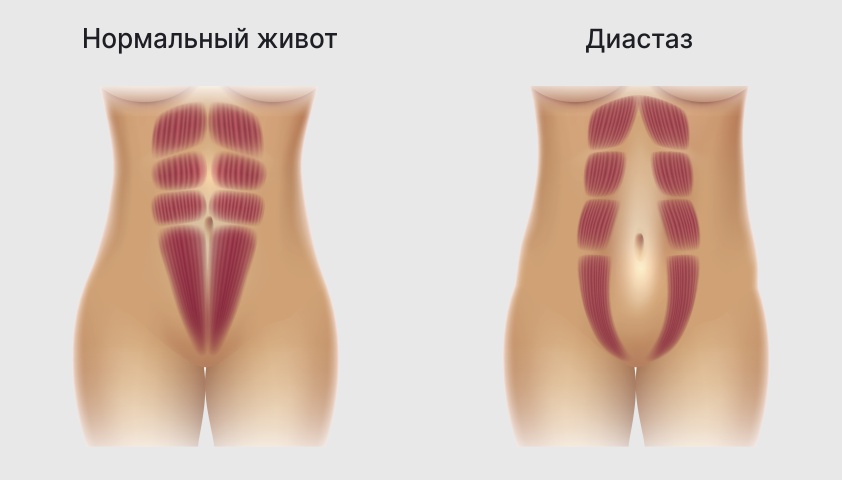 Живот после родов – как убрать и через сколько уходит