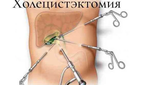  Стоимость эндоскопической холецистэктомии в России 