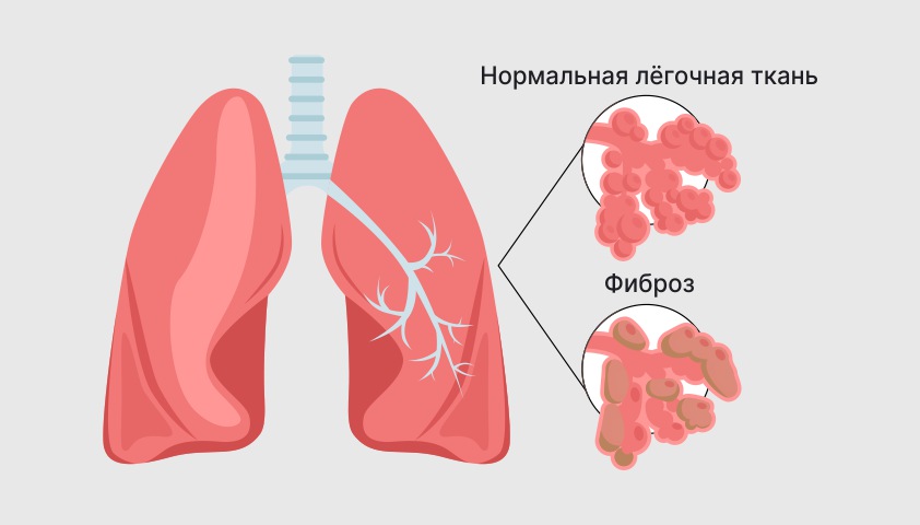 Фиброз лёгких — что это, опасен или нет, симптомы, лечение