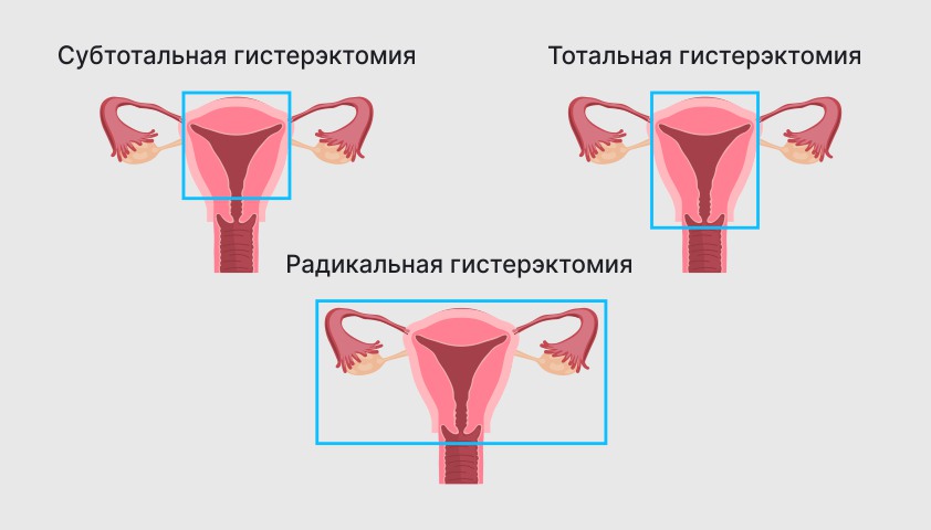 Гиперплазия эндометрия матки — что это, симптомы и лечение