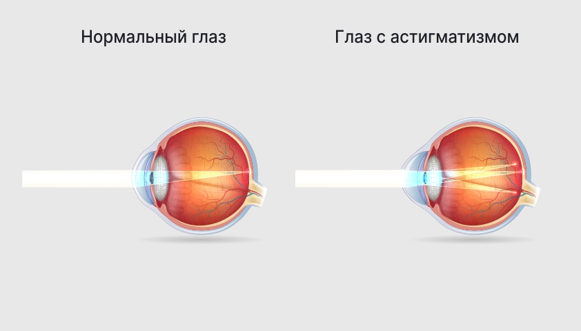 Глаукома - что это, симптомы, признаки и лечение