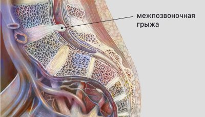 Пупочная грыжа у детей (новорождённых, подростков) — симптомы и лечение