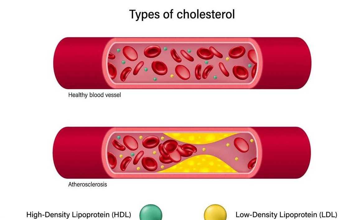Способы повысить уровень холестерина