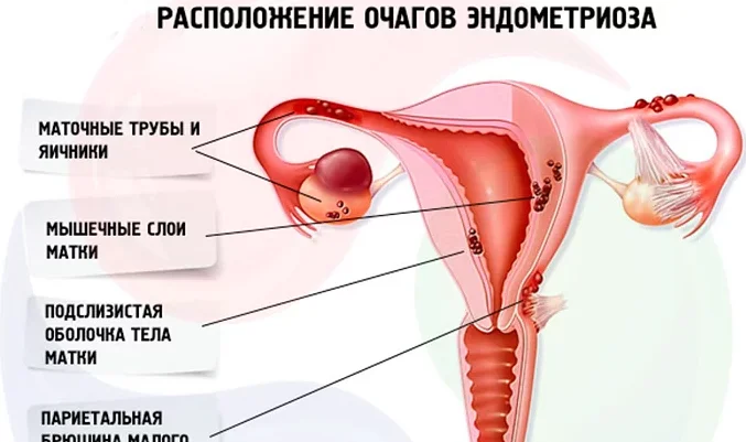 Последствия хирургического лечения эндометриоза у женщин