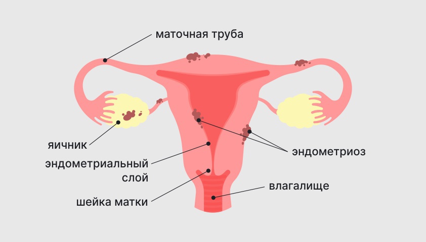 Аденомиоз - что это такое у женщин, симптомы, причины, лечение