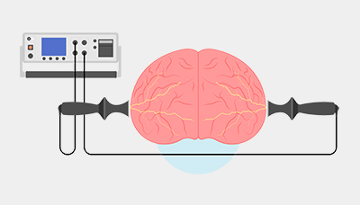 Электрическая стимуляция мозга