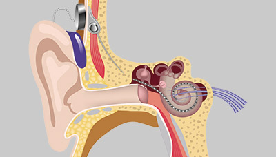 Изображение кохлеарного имплантата