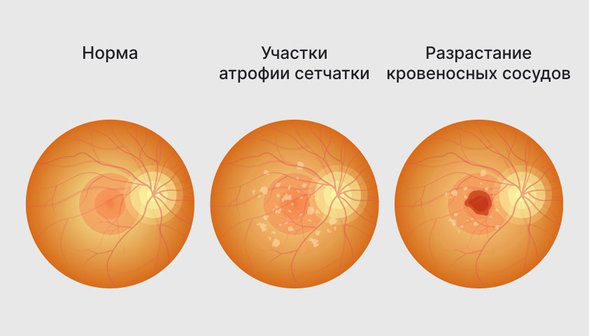 Макулодистрофия (макулярная дегенерация) — что это такое, причины дистрофии макулы, лечение и профилактика