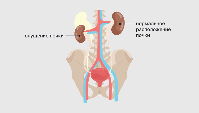 Нефроптоз (опущение почки) — что это, симптомы и лечение