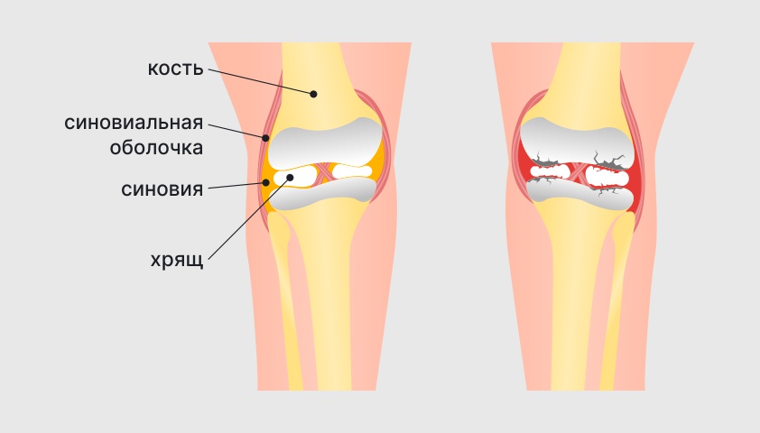 Остеоартроз