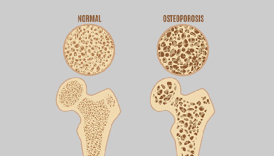 При остеопорозе меняется структура костей