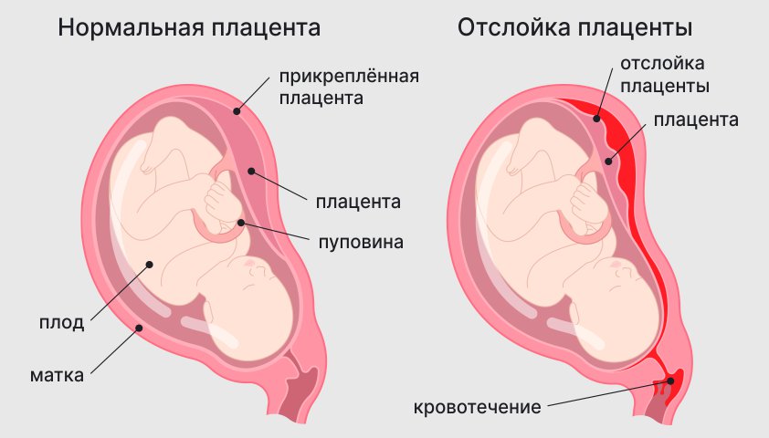 Тянет низ живота при беременности - что делать?