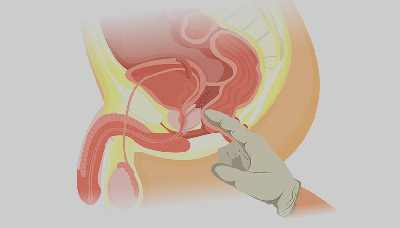 Пальцевое ректальное исследование простаты