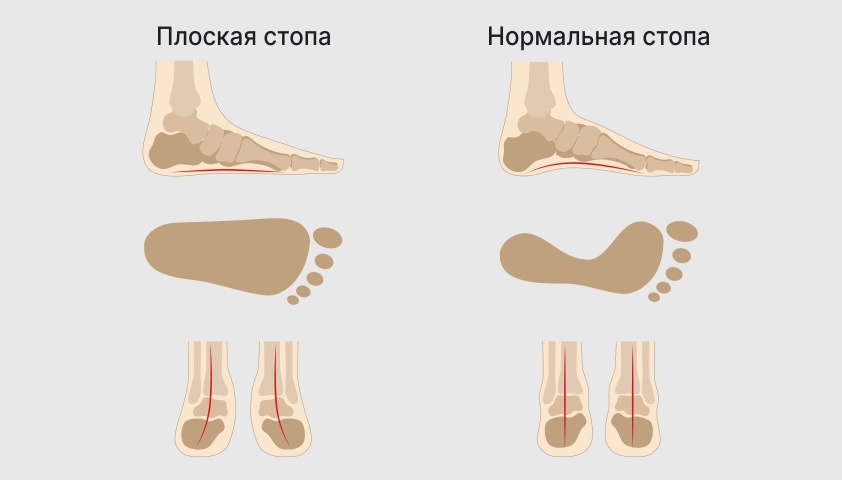 Как выглядит плоскостопие