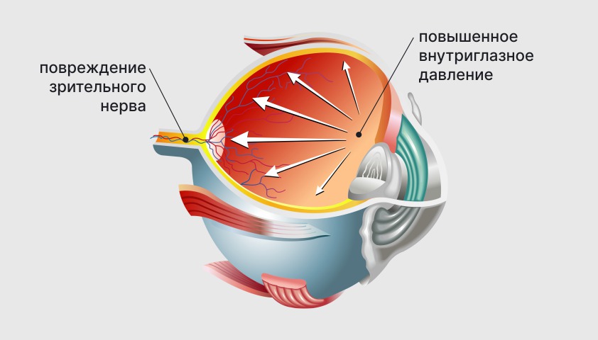 Глаукома - что это, симптомы, признаки и лечение