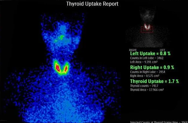Как проходит само исследование сцинтиграфии щитовидной железы?