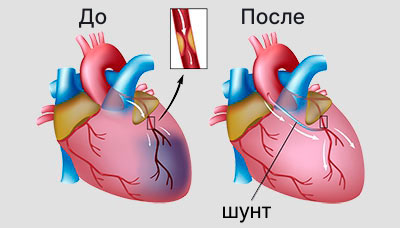 Шунтирование2