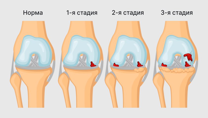 Стадии-геморроя-во-время-беременности