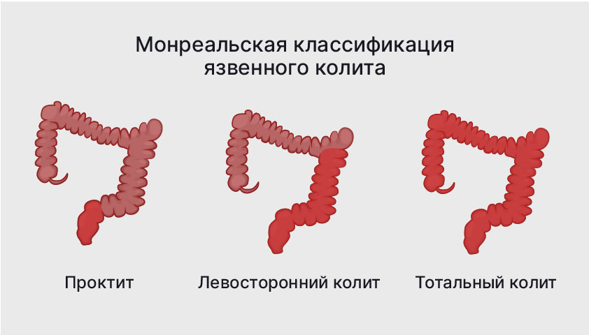 Неспецифический язвенный колит - что это, причины и симптомы