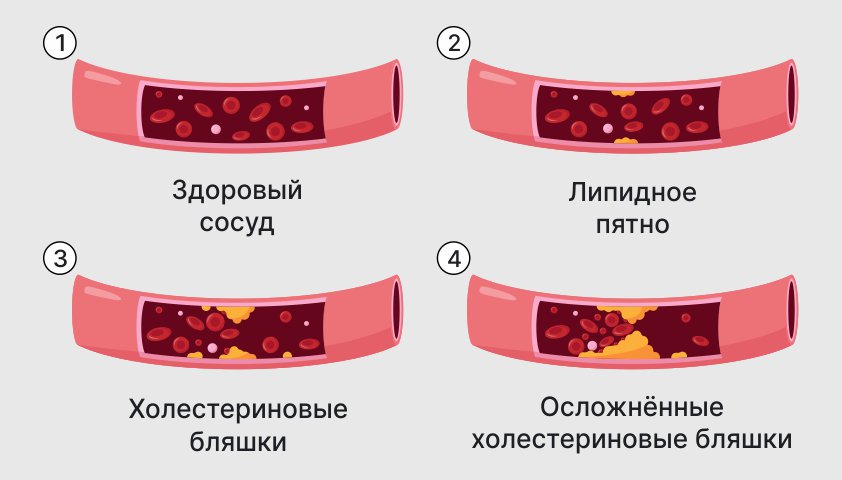 Патология атеросклероза