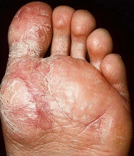 Уход за кожей при сухой экземе на руках и ногах