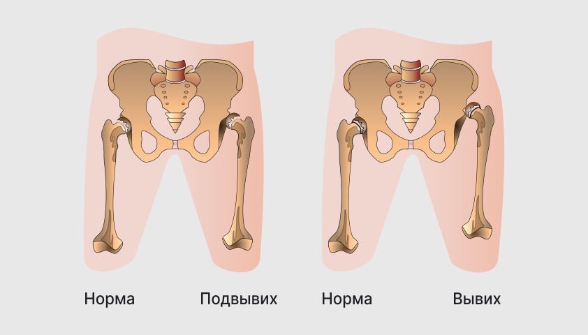 Дисплазия тазобедренного сустава и врождённый вывих бедра — что это, лечение