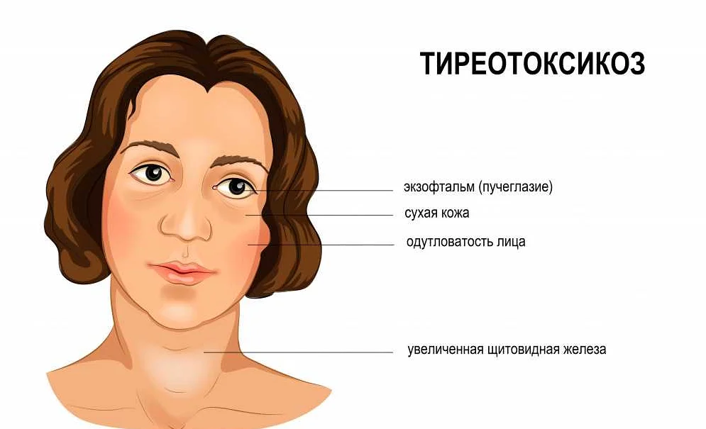 Диагностика тиреотоксикоза гипертиреоза