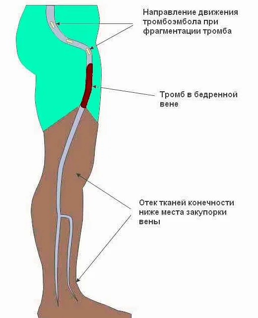 Хирургическое лечение тромбоза ноги