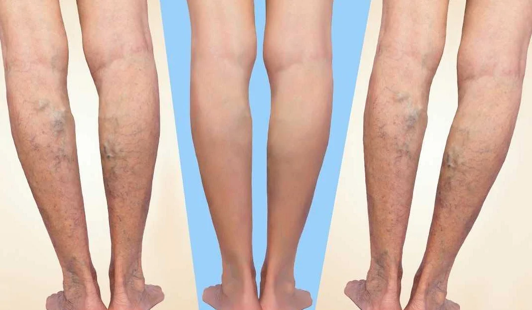Немедикаментозные методы лечения тромбоза ноги