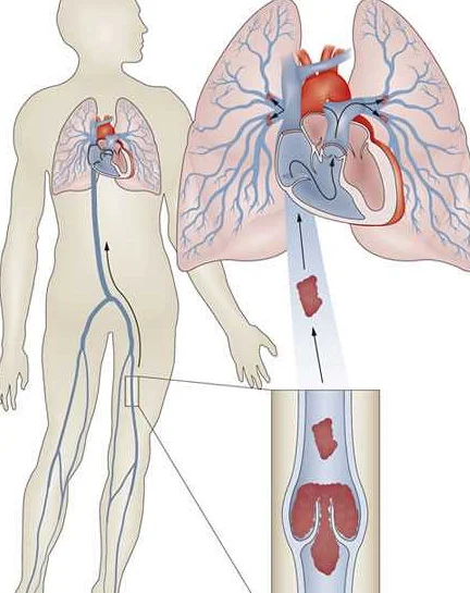 Прогноз и возможные осложнения тромбоэмболии легочной артерии