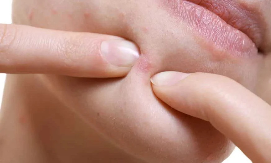 Угревая сыпь у женщин в период менопаузы